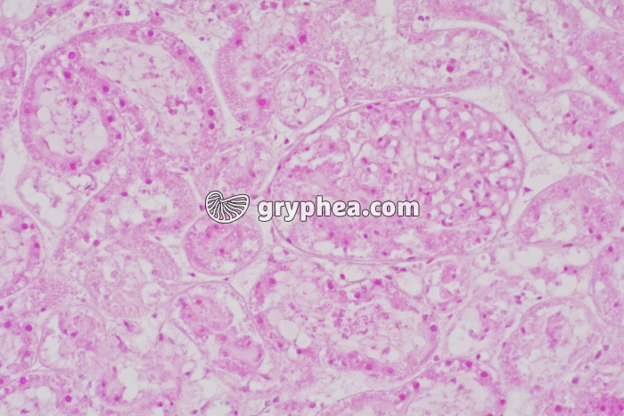 Rejet de greffe de rein x100 - gryphea.org